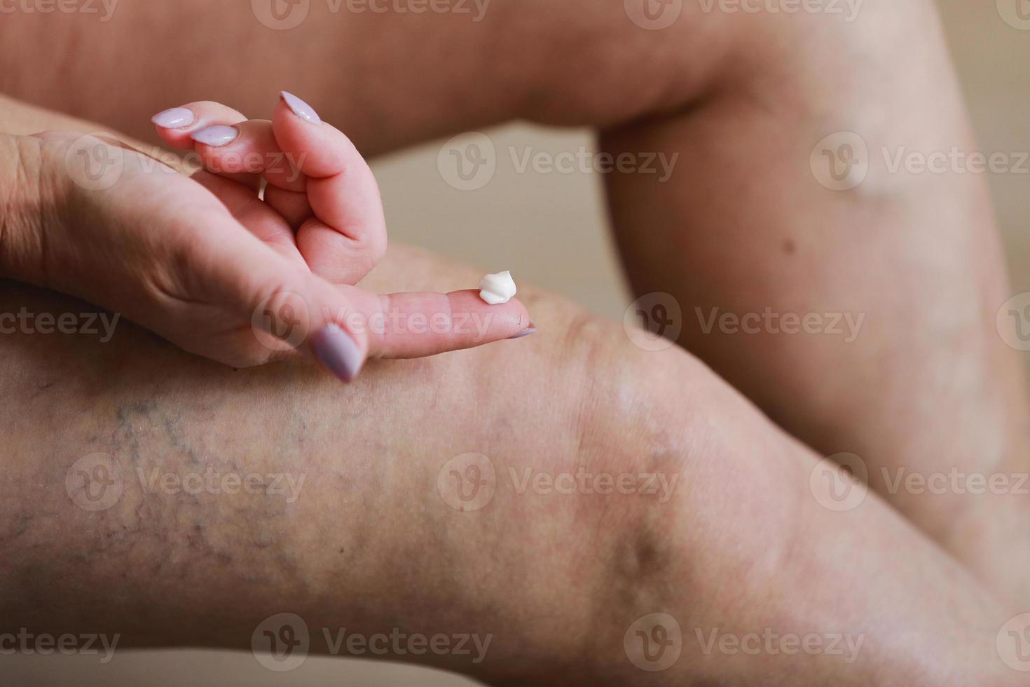 a mulher esfrega as pernas cansadas com um creme especial para diminuir a dor. flebologia. varizes dolorosas e veias da aranha nas pernas femininas ativas, remédios e saúde. foto