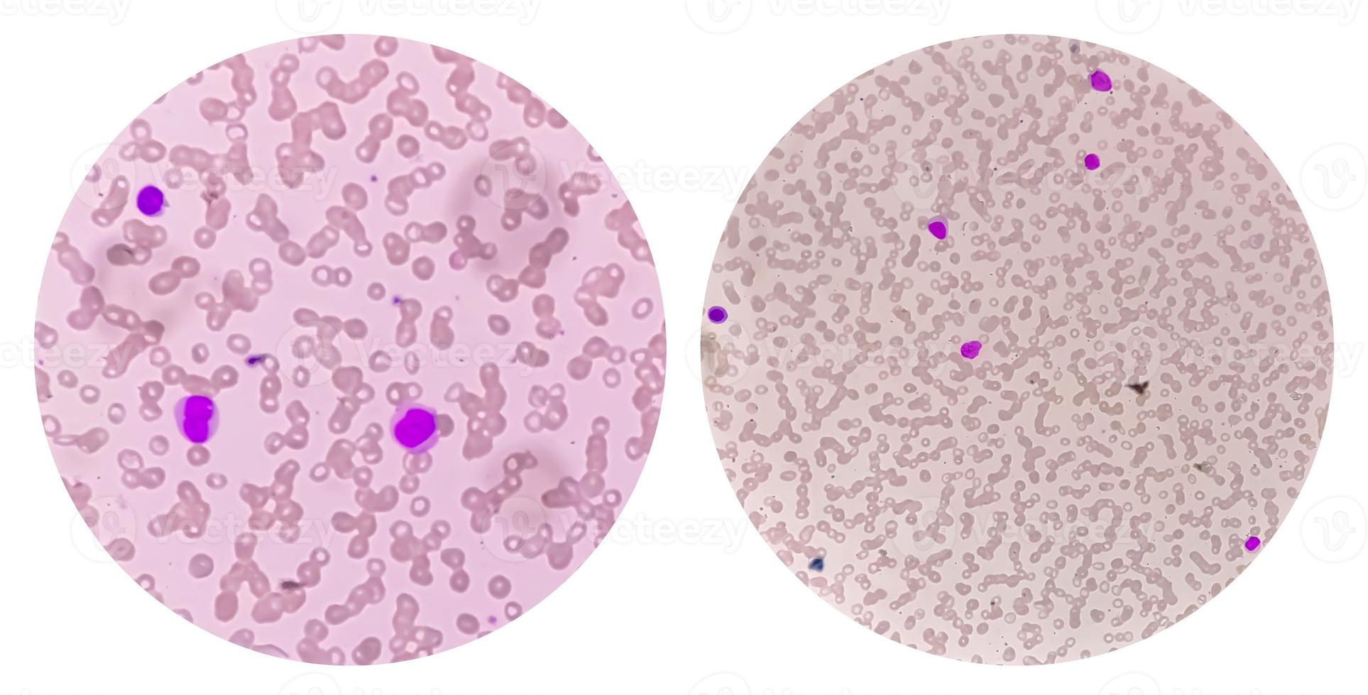 hemograma de leucemia mieloide aguda-aml. analisar por microscópio foto