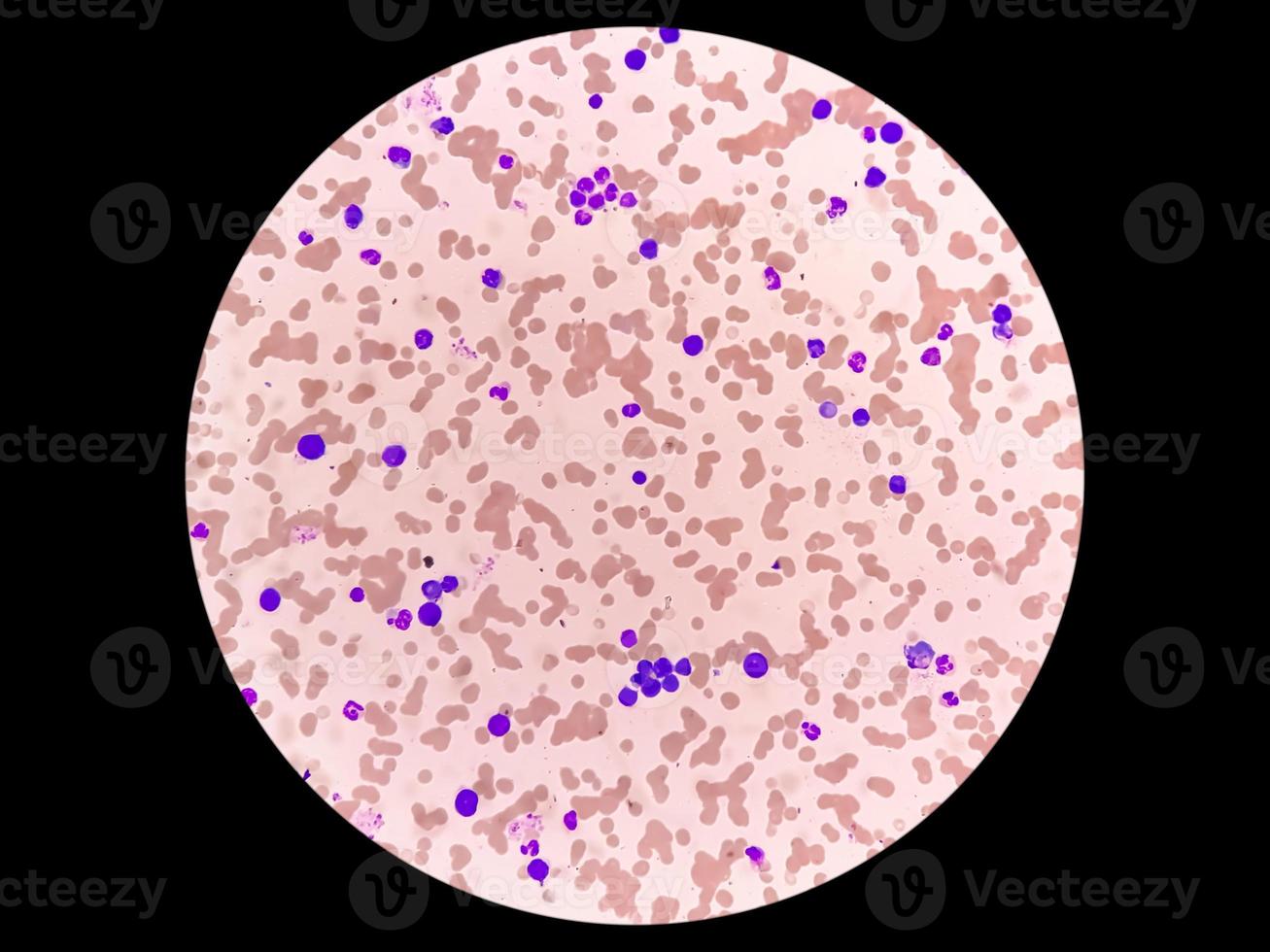 imagem microscópica de leucemia de células plasmáticas ou macroglobulinemia de waldenstrom. foto