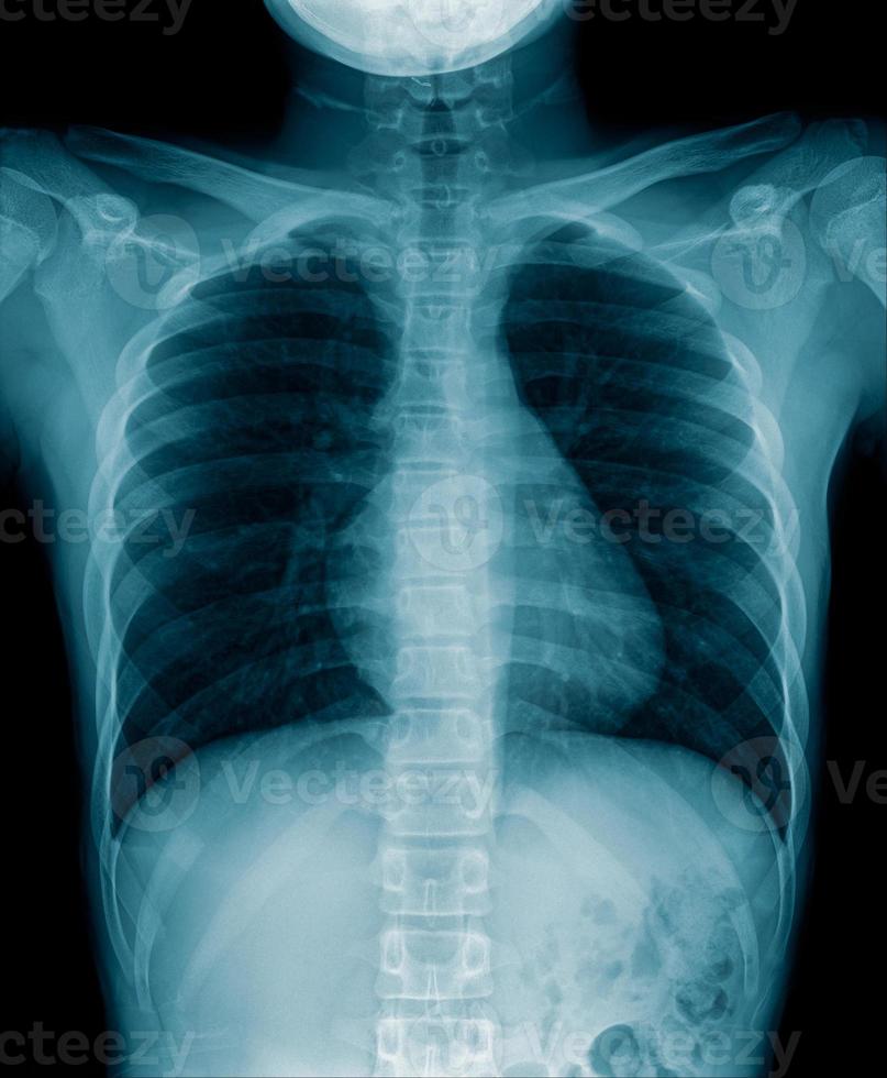 imagem de raio-x de tórax de paciente covid-19 em imagem de tom azul foto