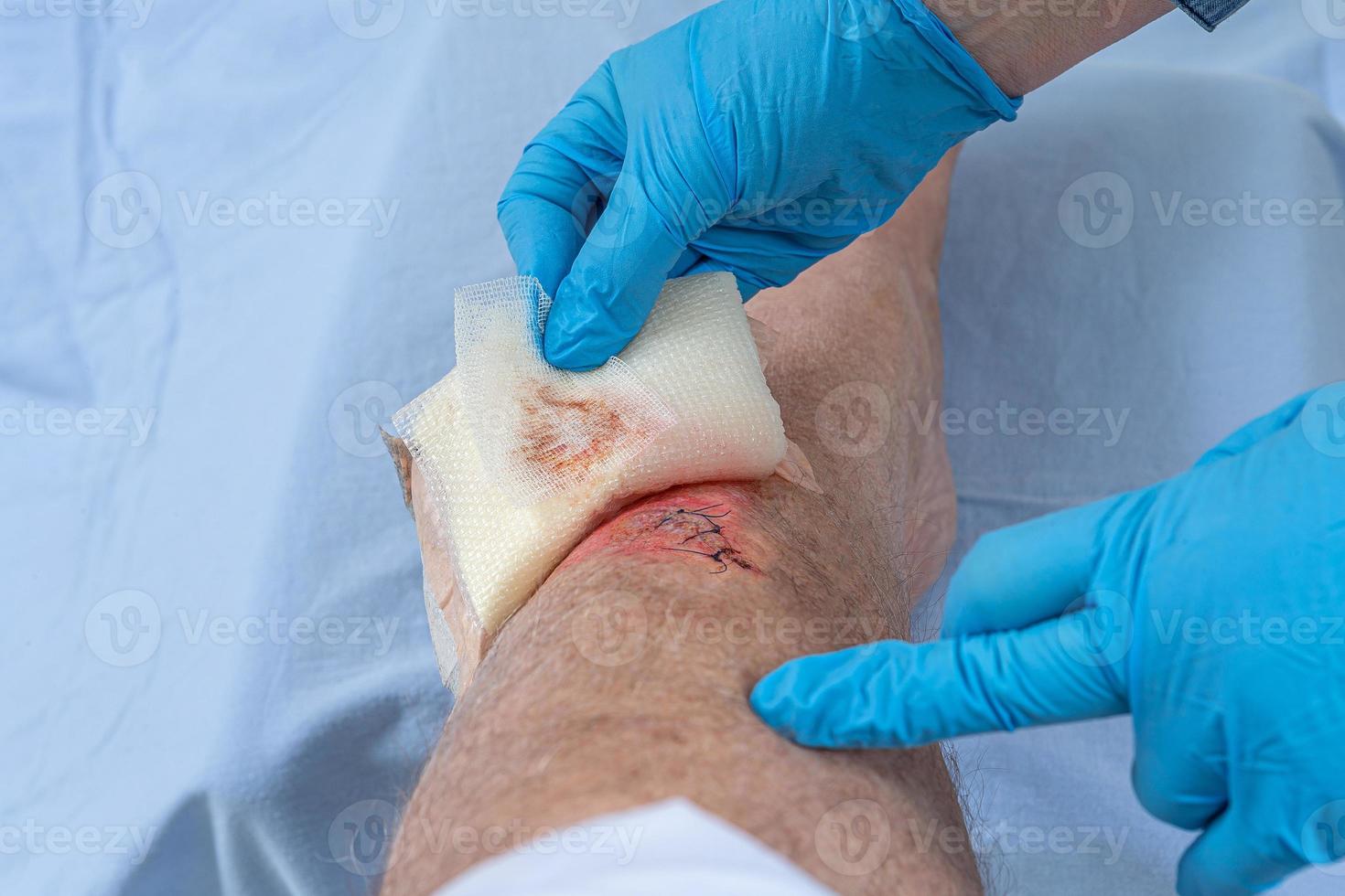 enfermeira cuidando de ferimento de sangue fresco no osso tibial da perna. pontos colando para segurar o corte. foto