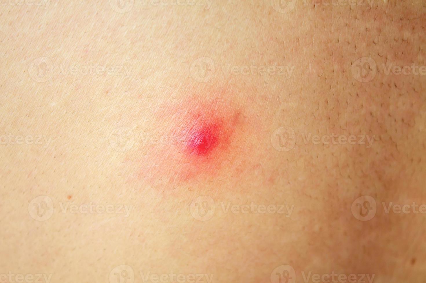acne com manchas vermelhas nas costas foto