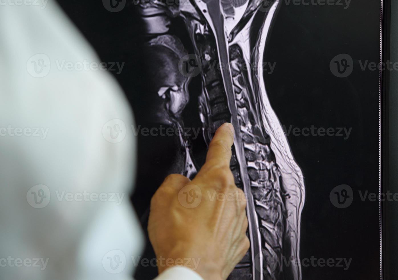 médico apontando para ressonância magnética da coluna cervical foto