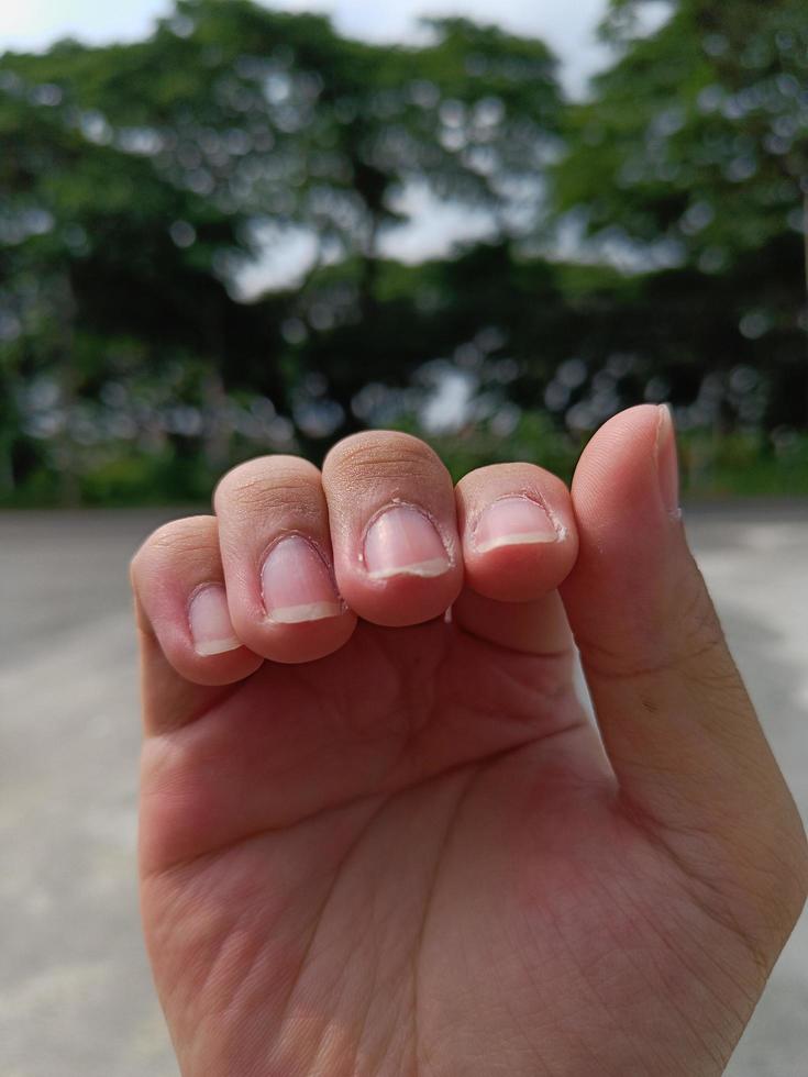 unha quebrada em seu dedo. cuidados com as unhas e saúde foto