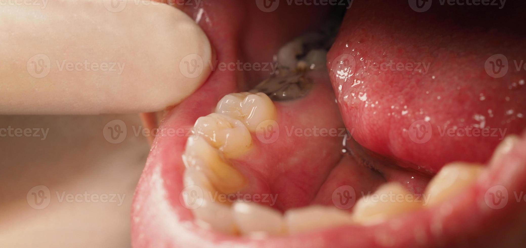 tratamento de canal de dente cariado. dente ou cárie dentária do molar inferior. foto