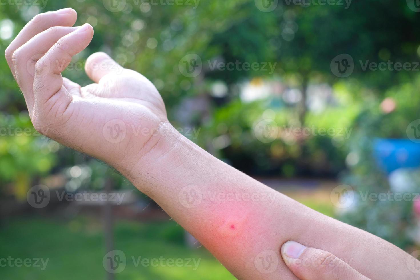 braços inchados devido a picadas de mosquito, animais venenosos, praga na estação chuvosa foto