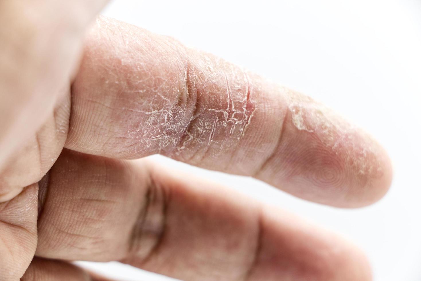 doença de pele do dedo indicador em fundo branco foto