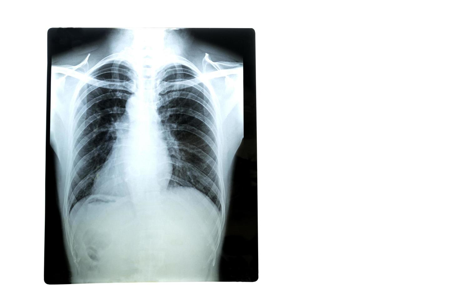 filme de raio-x dos pulmões de um paciente do sexo masculino no hospital em um fundo branco. foco suave. foto