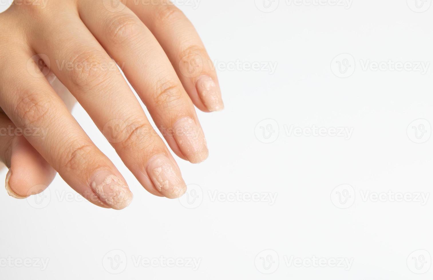 líquido para remoção caseira de esmalte de gel em ação na mão de uma mulher foto