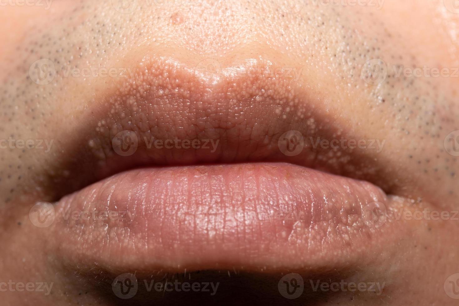 close-up de manchas de fordyce nos lábios. foto