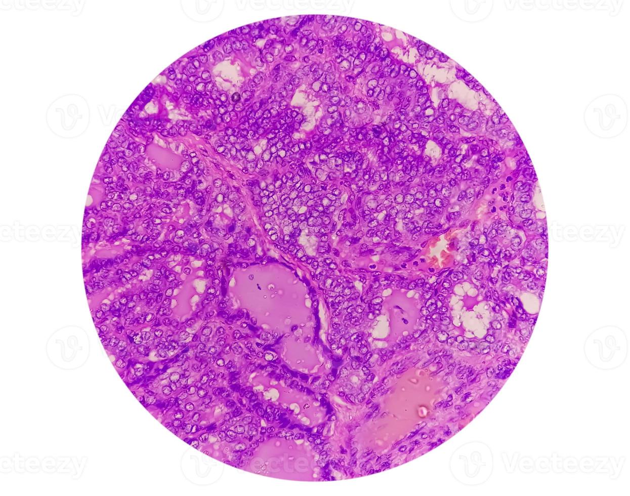 câncer de tireoide, imagem microscópica de carcinoma papilífero metastático de tireoide, linfonodo central. foto