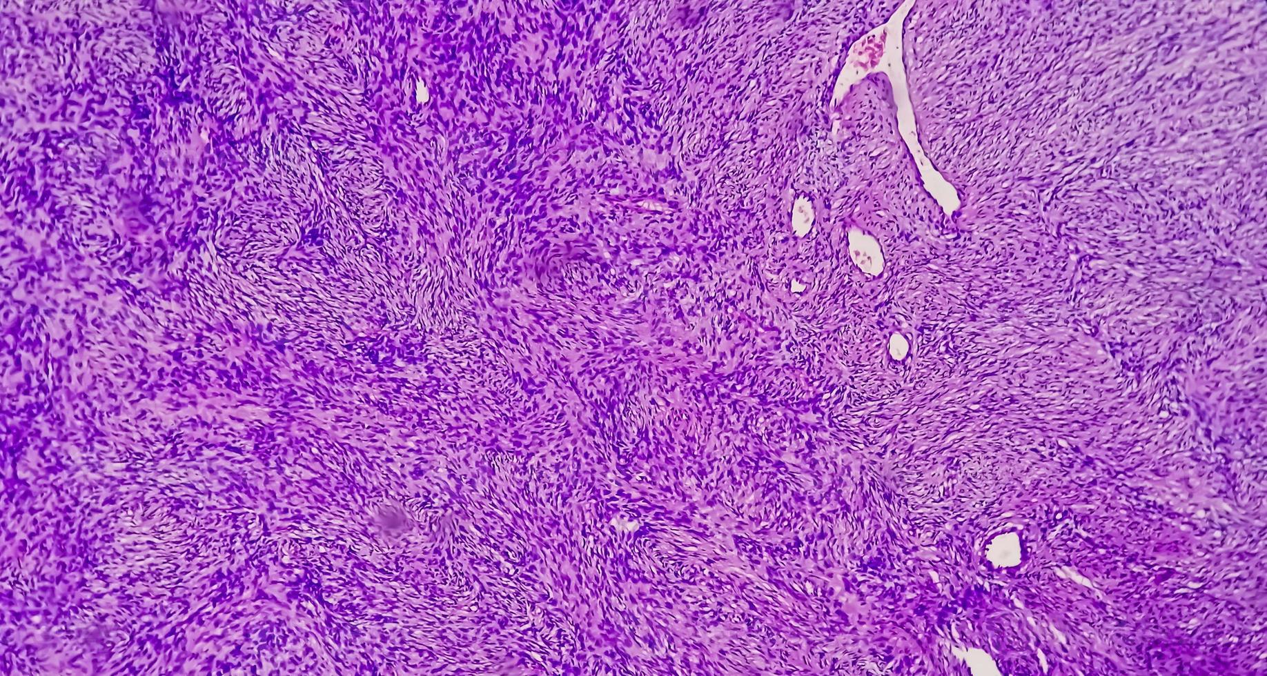 fotomicrografia de um schwannoma, um tumor benigno de tecidos moles da bainha do nervo periférico. foto