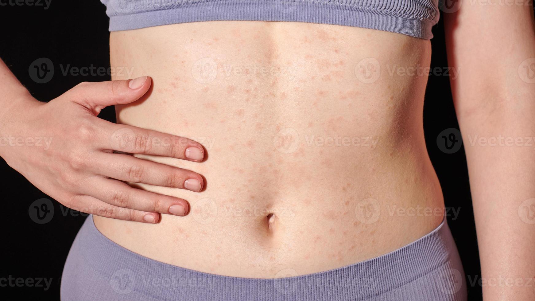 erupção alérgica vermelha na pele do estômago, alergia na pele, dermatite atópica, eczema. mulher aplicando pomada foto