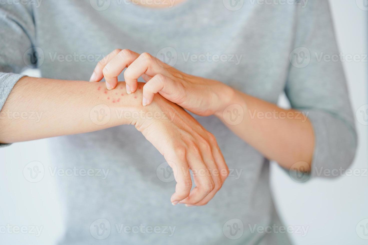 uma mulher coçando o braço, experimentando uma reação alérgica ou sendo picada por um inseto. conceito de doença de pele. foto