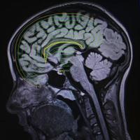 ressonância magnética do cérebro foto
