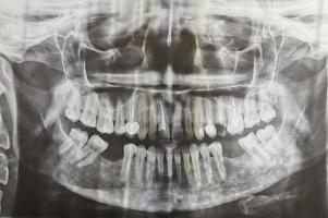 radiografia odontológica. digitalização de dentes de raio-x digital de fêmea adulta. vista frontal de raio-x de dentes humanos foto