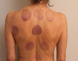 uma mulher que fez terapia de ventosa nas costas para dor