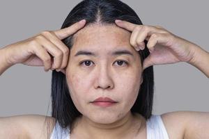 close-up do rosto de mulher adulta asiática tem sardas, poros dilatados, problema de espinha e cicatrizes de cravo por não cuidar por um longo tempo. foco suave do rosto do problema de pele. conceito de tratamento e cuidados com a pele foto
