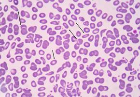 ovalócito de glóbulos vermelhos. foto