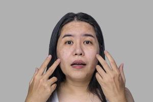 rosto de mulher adulta asiática tem sardas, poros dilatados, espinhas e cicatrizes problema de não cuidar por um longo tempo. problema de pele rosto isolado fundo cinza. conceito de tratamento e cuidados com a pele foto