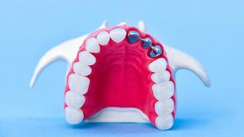 processo de instalação de implante e coroa dentária foto