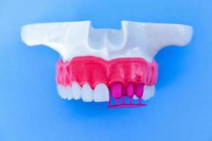 processo de instalação de implante e coroa dentária foto