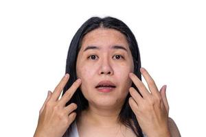 rosto de mulher adulta asiática tem sardas, poros dilatados, espinhas e cicatrizes problema de não cuidar por um longo tempo. problema de pele rosto isolado fundo branco. conceito de tratamento e cuidados com a pele foto