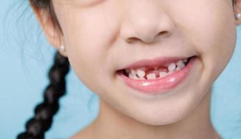 menina criança closeup sorrindo com dentes soltos, odontologia e conceito de cuidados de saúde foto