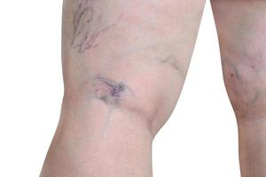 mulher expondo a perna com varizes na perna mostra varizes capilares isolada em um fundo branco foto