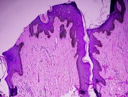 biópsia histológica da parede escrotal à microscopia mostrando calcinose cutânea. calcinose escrotal. calcinose cutânea do escroto foto