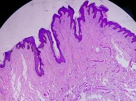 biópsia histológica da parede escrotal à microscopia mostrando calcinose cutânea. calcinose escrotal. calcinose cutânea do escroto foto