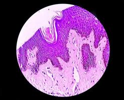 biópsia histológica da parede escrotal à microscopia mostrando calcinose cutânea. calcinose escrotal. calcinose cutânea do escroto foto