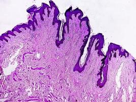 biópsia histológica da parede escrotal à microscopia mostrando calcinose cutânea. calcinose escrotal. calcinose cutânea do escroto foto