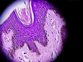 biópsia histológica da parede escrotal à microscopia mostrando calcinose cutânea. calcinose escrotal. calcinose cutânea do escroto foto