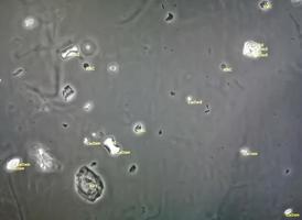imagem microscópica de urinálise anormal. exame de urina. exame de rotina de urina. foto