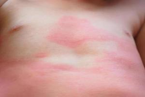 eczema grave erupção cutânea e sintoma de reação alérgica no corpo da criança asiática pequena causa por hipersensibilidade foto