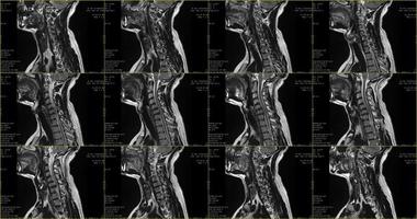 conjunto de exames de ressonância magnética sagital da área do pescoço de homem caucasiano de 34 anos com extrusão paramedial bilateral do segmento c6-c7 com radiculopatia foto