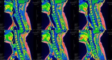 conjunto de 6 exames de ressonância magnética sagitais de cor verde da área do pescoço de um homem caucasiano de 34 anos com extrusão paramedial bilateral do segmento c6-c7 foto