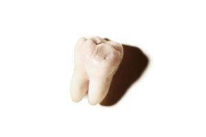 dente do siso com cárie dentária, fundo branco isolado foto
