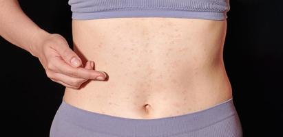 erupção alérgica vermelha na pele da barriga, dermatite atópica, eczema, inflamação. mulher aplicando pomada foto
