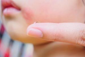 mãe aplicando creme anti-histamínico tópico no rosto de criança com erupção cutânea e alergia com mancha vermelha causada por picada de mosquito foto