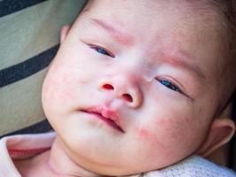 bebê recém-nascido com alergia no rosto foto