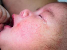 bebê recém-nascido com alergia no rosto foto
