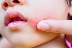 mãe aplicando creme anti-histamínico tópico no rosto de criança com erupção cutânea e alergia com mancha vermelha causada por picada de mosquito foto