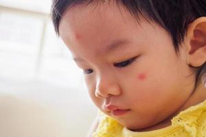 menina asiática bonitinha com cara de mancha vermelha de alergia causada por picada de inseto foto