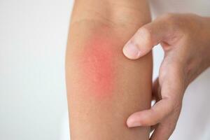 homem coçando e coçando no braço de dermatite eczema de pele seca com coceira foto