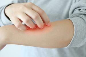 jovem mulher asiática coçando e coçando no braço de dermatite eczema de pele seca com coceira foto