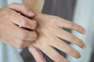 jovem asiático coçando e coçando na mão de dermatite eczema de pele seca com coceira foto