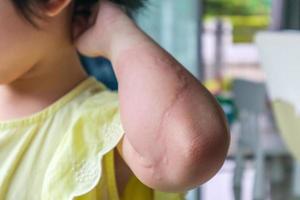 menina tem alergia de erupção cutânea e coceira no braço foto