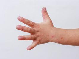 doença mão-pé-boca hfmd mão humana de escarlatina em enterovírus de palma foto